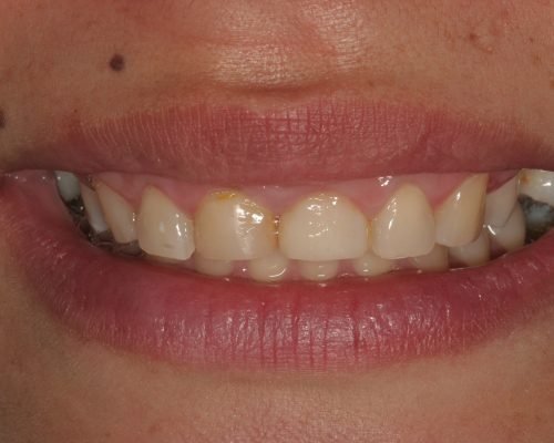 Antes